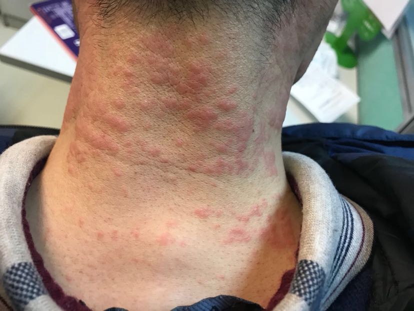 1、膏藥過敏怎么辦？