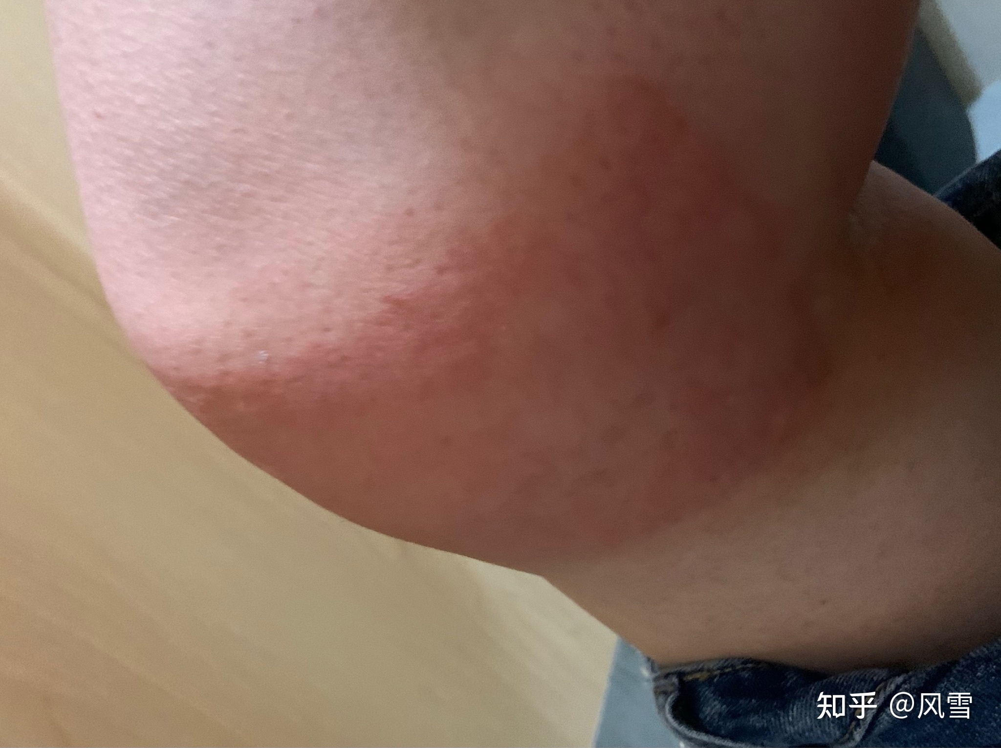 1、貼膏藥過(guò)敏癢紅腫怎么辦？