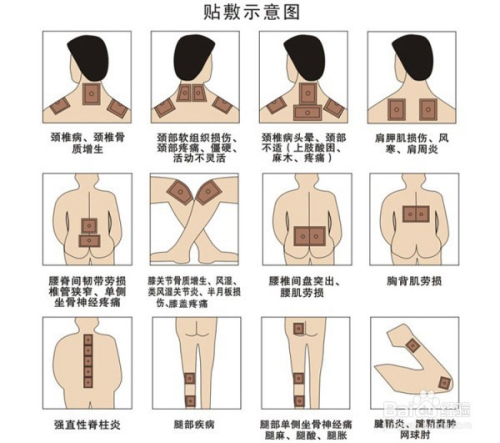 1、肩痛買什么膏藥可以貼？