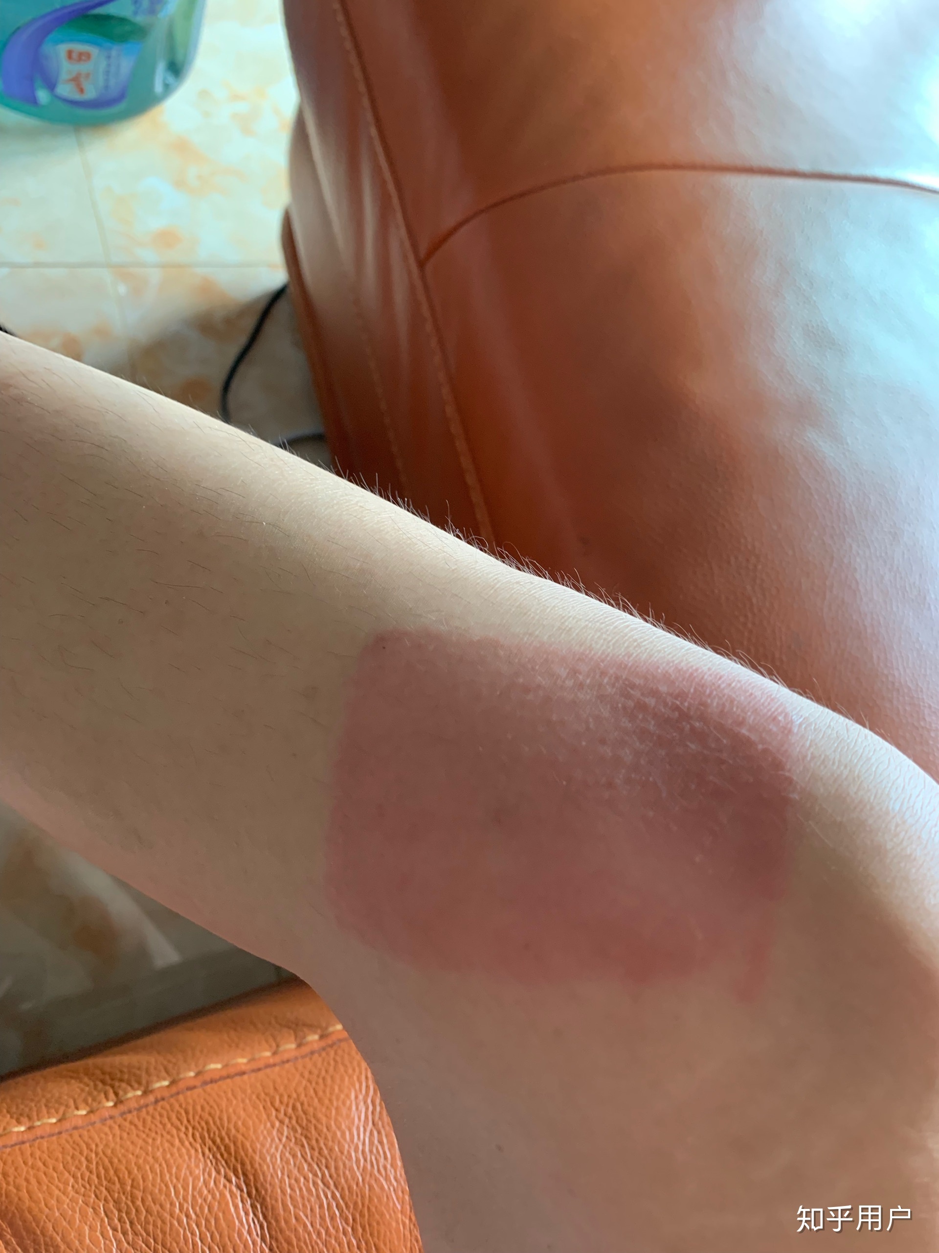 2、貼膏藥的地方有很多紅疙瘩，好不好？